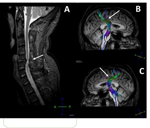 Daño cerebral en pacientes con hernias cervicales. Imagen: CIBER.