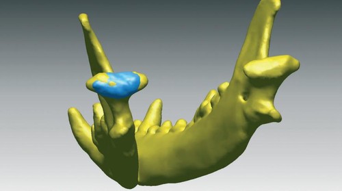 Mandíbula diseñada en 3D./International Journal of Medical Robotics and Computer Assisted Surgerys.