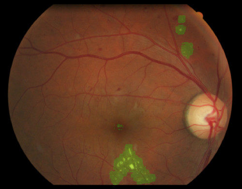 Sistema de detección temprana de daños en la retina. Imagen: UPV.