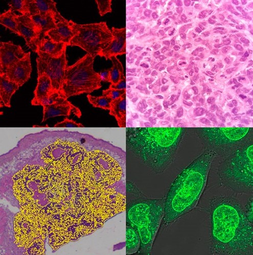 Imágenes de células cultivadas in vitro y tumores de osteosarcoma empleados en el estudio. Fotos: gentileza investigadores.