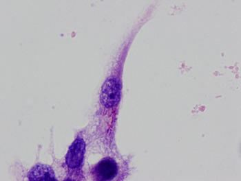 Macrófagos humanos infectados con Mycobacterium tuberculosis