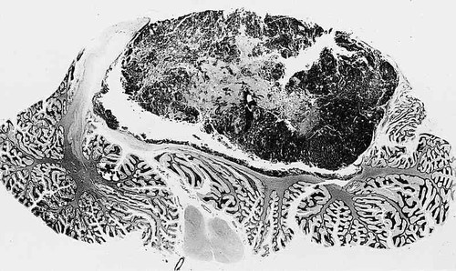 Meduloblastoma/AFIP Atlas of Tumor Pathology