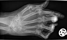 RadiografÃ­a de la mano de un paciente con artritis reumatoide (imagen: Wikipedia)