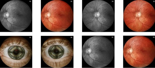 Eyer, el dispositivo que detecta retinopatías a un costo más bajo que con los métodos convencionales.