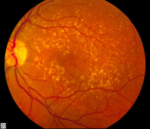 Imagen de una retina afectada por degeneración macular asociada a la edad. 