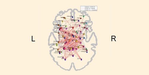 El COVID-19 puede alterar el patrón de conectividad funcional del cerebro/Brunno Machado de Campos/Unicamp