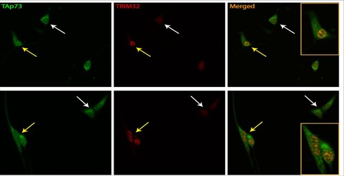 La expresión nuclear del factor de transcripción TAp73 (verde) correlaciona (flechas amarillas) con  un incremento en la expresión de TRIM32 (rojo) colocalizando ambas proteínas en el núcleo  celular (amarillo). FOTO: Carmen Marín.