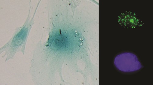 Izquierda: células senescentes. Derecha: núcleo celular mostrando foco de daño al ADN (arriba) y su control (abajo). Imágenes: CIBER.