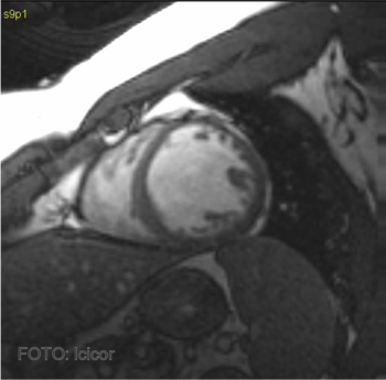 Imagen de resonancia magnética en la que se observan dos ventrículos.