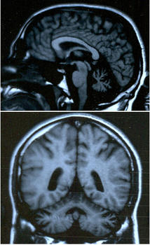 Imagen de resonancia magnétiva de un paciente de ataxia de 25 años (FOTO: Nicolaou et al.)