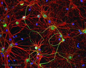 Neuronas afectadas por alzhéimer.