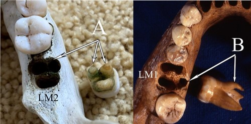 A) Segundo molar con tres raíces encontrado en una población americana actual, potencialmente similar a la identificada en el denisovano de Xiahe y B) molar con tres raíces cuya frecuencia es mayor en algunas poblaciones asiáticas en el primer molar.