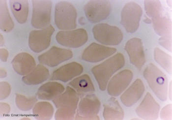 'Plasmodium falciparum' en glóbulos rojos.