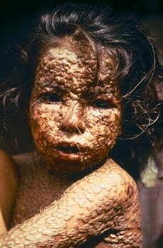 This young girl in Bangladesh was infected with smallpox in 1973. Freedom from smallpox was declared in Bangladesh in December, 1977 when a WHO International Commission officially certified that smallpox had been eradicated from that country.