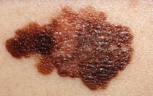 Melanoma en la piel de un paciente.