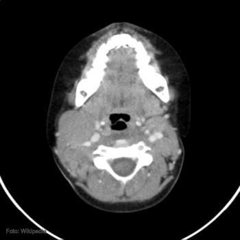 Tomografía computerizada de un linfoma no-Hodgkin altamente maligno en una garganta.