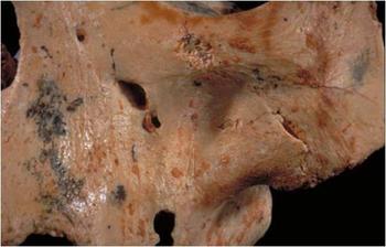 Cráneo de 'Homo antecessor' con claros signos de mordeduras (FOTO: IPHES).