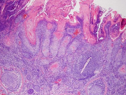 Ejemplo de un tumor espontáneo en la cavidad oral de ratones carentes de p53 en este epitelio. Foto: CIEMAT.