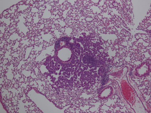 Ejemplo de un carcinoma de pulmón incipiente. Foto: CIEMAT.