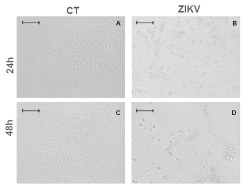 Efectos citopáticos de la infección por el virus del Zika en células humanas de gliobastoma/ Laboratorio Innovare de Biomarcadores de la Unicamp