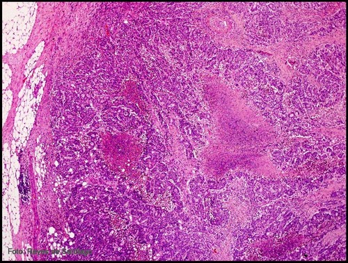 Imagen patológica de un cáncer colorrectal.