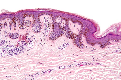 Imagen microscópica de un melanoma, uno de los cánceres más graves que se representa en la piel. Imagen: F. Descubre.