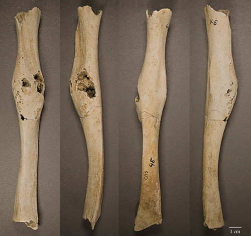 Tumor óseo identificado en el brazo superior derecho de un adolescente que fue enterrado alrededor del 1300/STRI