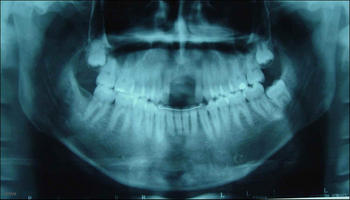 A través de una radiografía digital podría detectarse la pérdida de densidad mineral ósea del periodonto.