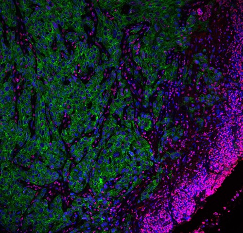 Frente de células tumorales invasivas (en verde). Imagen de microscopía confocal. Autora: Alexandra Avgustinova, IRB Barcelona.
