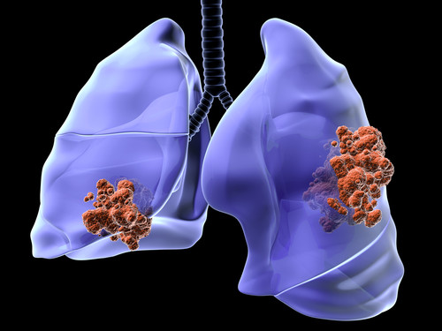 Ilustración representativa del cáncer de pulmón. / iStock.