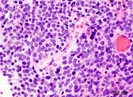 Linajes de meduloblastoma, el tipo de cÃ¡ncer cerebral mÃ¡s comÃºn en niÃ±os (imagen: Wikimedia Commons)