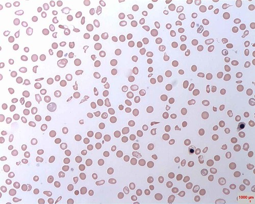 Anemia hemolítica/Prof. Osaro Erhabor