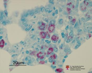 Neumonía intersticial y presencia de las bacterias 'Mycobacterium avium'.