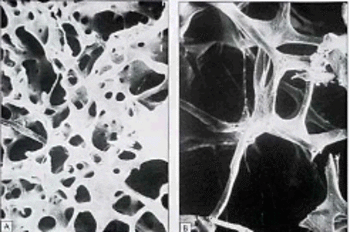 Imagen del estado interno de un hueso sano y de uno afectado por osteoporosis