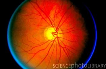 Imagen de un ojo con glaucoma.