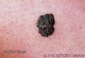 Imagen de un melanoma cutáneo.