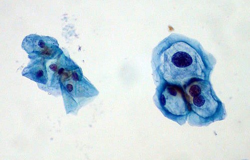Izquierda: células normales; derecha: células infectadas por VPH. 