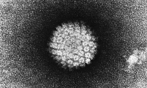 Carcinoma de orofaringe inducido por VPH. FOTO: Wikimedia