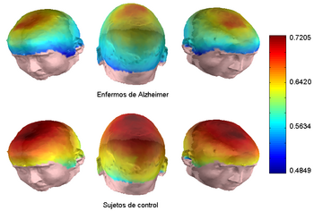 Imagen que representa las diferencias en cuanto a la complejidad promedio de la actividad cerebral en dos grupos de sujetos bajo estudio: enfermos de Alzheimer y sujetos de control (FOTO: Grupo de Ingeniería Biomédica).