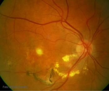 Foto de fondo de ojo en un paciente afecto de uveítis posterior presuntamente secundaria a tuberculosis.