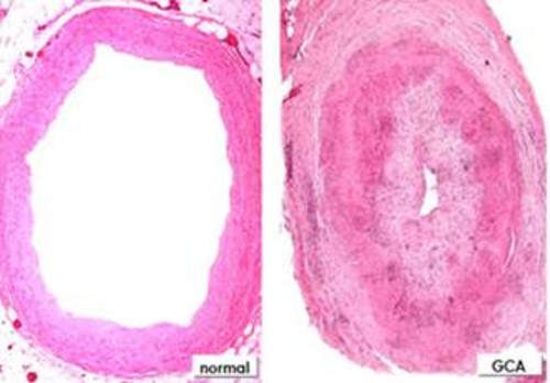 Arteria normal y patológica. Imagen: CSIC.