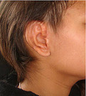 Apariencia de una oreja reconstruida. FOTO: UN 