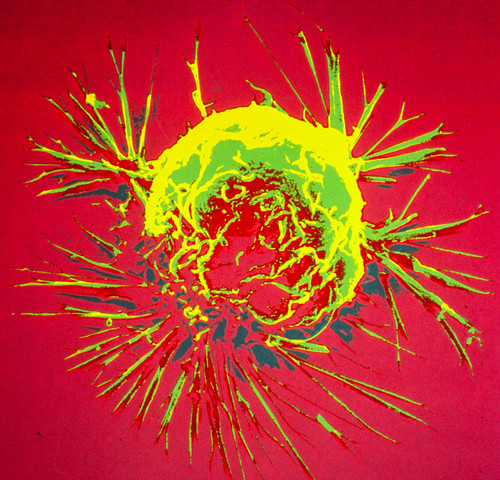 Célula de cáncer de mama fotografiada con un microscopio electrónico de barrido.