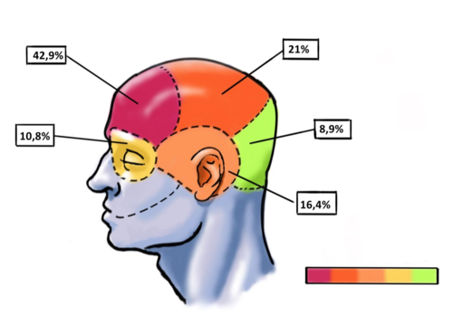La mayoría de los participantes en el estudio describió un dolor por toda la cabeza, especialmente por la zona frontal, opresivo y de intensidad elevada.