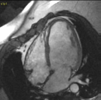 Resonancia magnética del corazón tras el tratamiento (FOTO: Icicor).