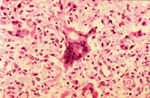 Células infectadas por el virus del sarampión. FOTO: CDC