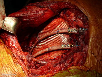 Imagen del implante de costillas en la pared torácica tras extirpación de un tumor