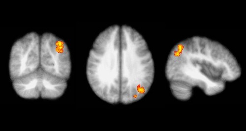 Exámenes de resonancia magnética funcional de personas que padecen mareos y que son refractarias al tratamiento sugieren una actividad exacerbada en las vías cerebrales relacionadas con la ansiedad y el miedo (imagen: divulgación)
