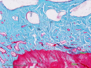 Técnica Goldner. En azul, el hueso maduro; en rosa, el inmaduro, sin mineralizar.