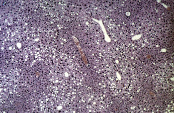 Imagen de un hígado con esteatosis. Los puntos blancos son cúmulos de grasa.